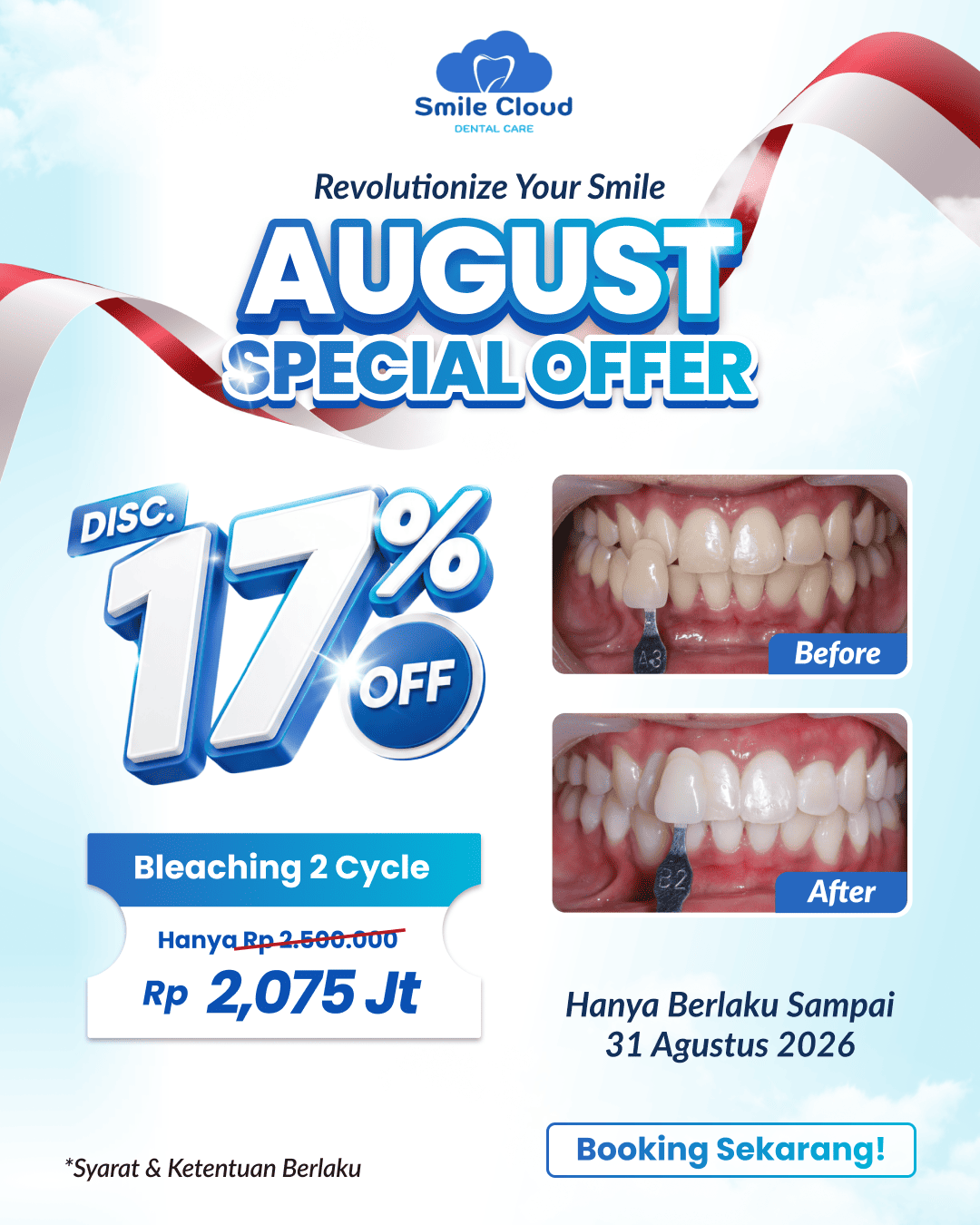 Promo Behel & Bleaching - Smile Cloud (2)